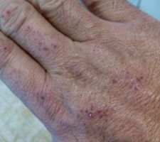 Résultat attaque du béton sur mes mains aie !