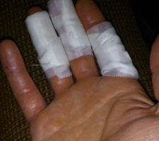 Peau complètement bouffé par la chaux!! et pourtant j'avais des gants!!!